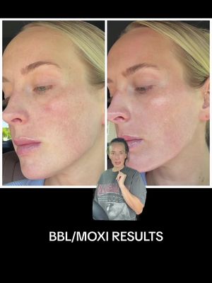 My BBL Moxi Laser Results: 7-10 Day Before & After